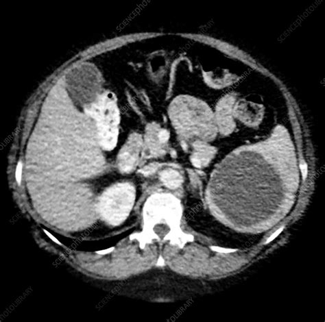 Ct Of Splenic Cyst Stock Image C0430401 Science Photo Library