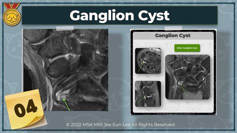 Anatomy04 Ganglion Cystlong Radiolunate Ligament