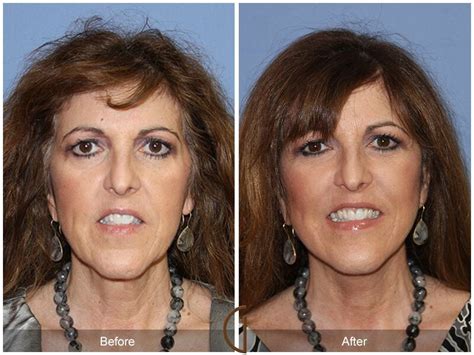 Facelift Fifties Before And After Photos Patient 69 Dr Kevin Sadati