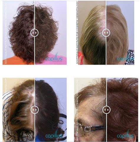 Women Before And After Capillus Hair Loss Treatment Willow Health And