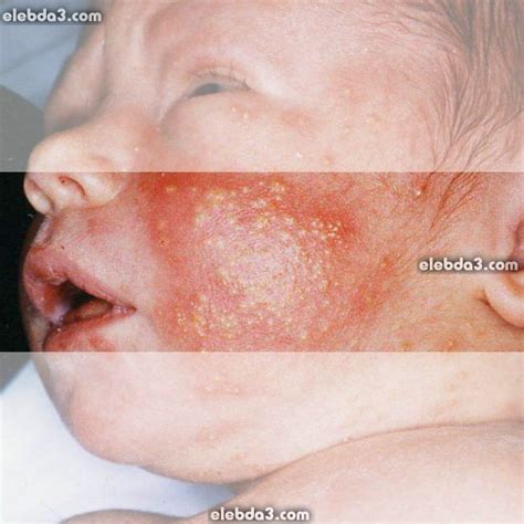 مدوّنة الامراض الجلدية عند الأطفال امراض الجلد 🖋️ مجلة الرياضة و الصحة