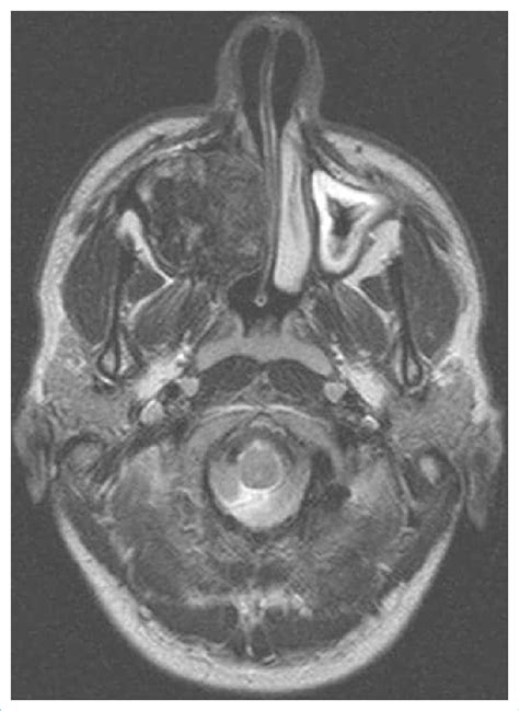 Preoperative Paranazal Sinus Mr Image Axial Download Scientific