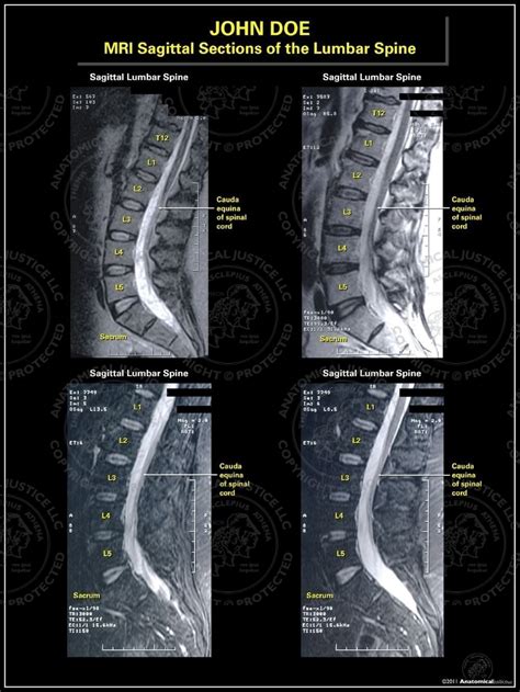 Mri Sagittal Sections Of The Lumbar Spine