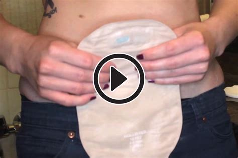Change An Ostomy Bag How To Video With Laura Cox