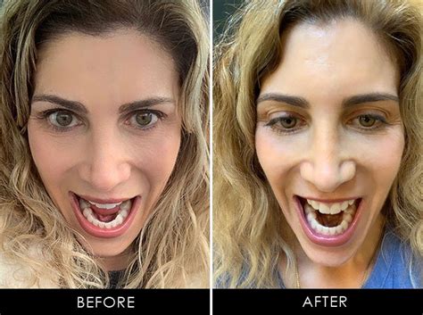 Majority of patients will wear a retainer for at least one full to determine exactly how long the retainer must be used, it is important to schedule follow up visits smile you're at dr. SmileDirectClub Giveaway & My Teeth Straightening Success ...