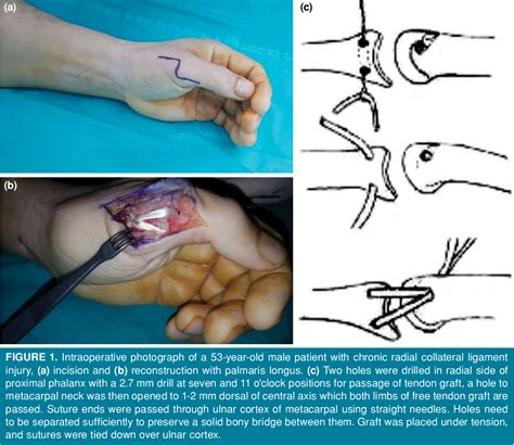 Figure From Reconstruction Of Chronic Thumb Metacarpophalangeal Radial Collateral Ligament