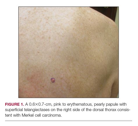 Merkel Cell Cancer Pdf Merkel Cell Carcinoma Of The Head And Neck