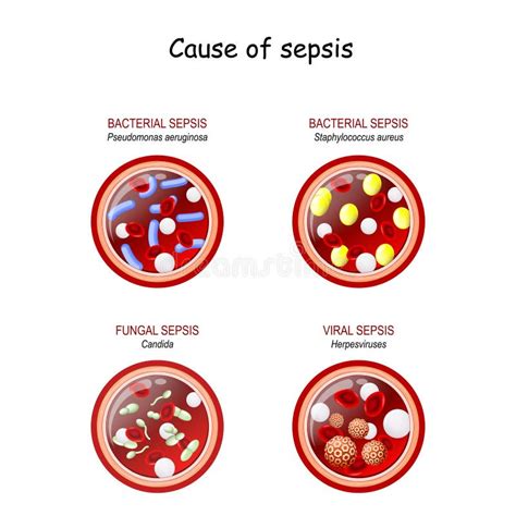 Cause Of Sepsis Close Up Of Cross Section Of Blood Vessel With Red