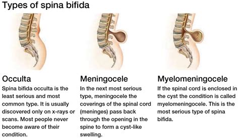 Diagnosis Focus Spina Bifida Shield Healthcare