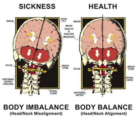 With Misaligned Neck Your Entire Spine Will Alter Its Position In An
