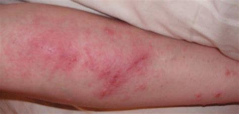 How To Get Rid Of Poison Oak Rash And Itch Healthfully