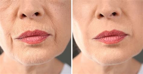 Laser Treatment For Wrinkles Cheap Collection Save 66 Jlcatjgobmx