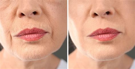 Wrinkle Treatment - Panorama Cosmetic Center | Panorama City