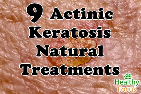 9 Actinic Keratosis Natural Treatments Healthy Focus
