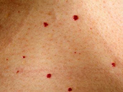 Cherry angioma/blood spots/campbell de morgan spots are clusters of tiny capillaries that form small round domes on the skin's surface. Treatment of skin lesions at BrightNewMe