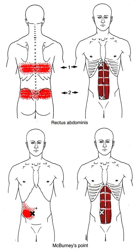 Rectus Abdominis The Trigger Point And Referred Pain Guide
