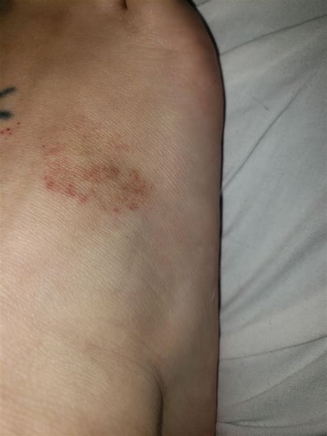 Redbrown Spots On My Foot Dr Says Its Age Spots But Im 31 R