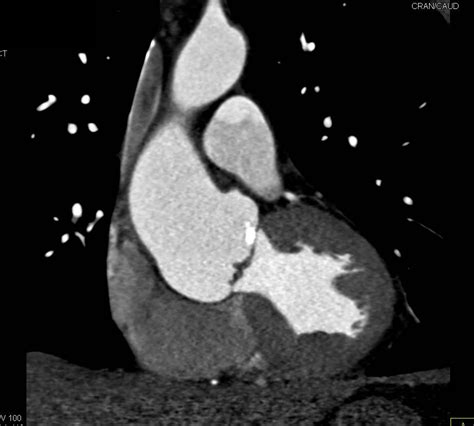 Aortic Valve Calcification With Aortic Stenosis And Dilated Ascending