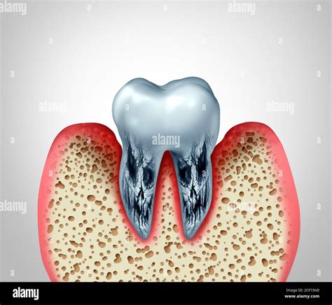 Dead Tooth With Cavities Hi Res Stock Photography And Images Alamy