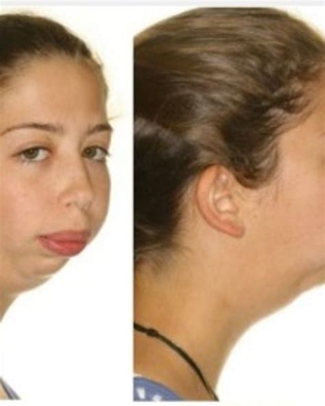 Photos Show Shocking Transformation Of Girl With Jaw Deformity Sexiz Pix