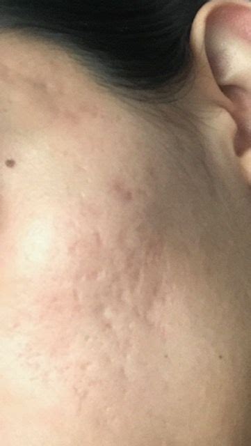 Help What Type Of Acne Scars Are These And How Can They Be Treated