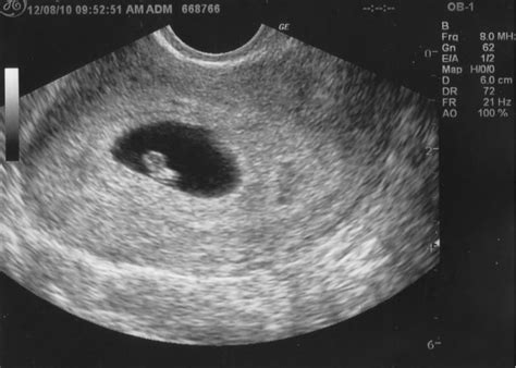 5 Week Ultrasound Pictures What Should An Ultrasound Show At 5 Weeks