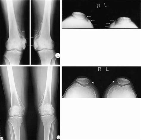 Radiography Of Knee Joints Before And After Resection A C Heterotopic