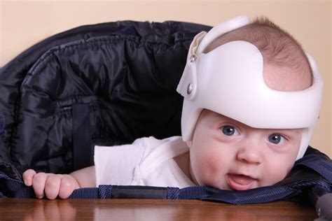 Helmet Or No Navigating The Flat Head Epidemic With Our Baby The