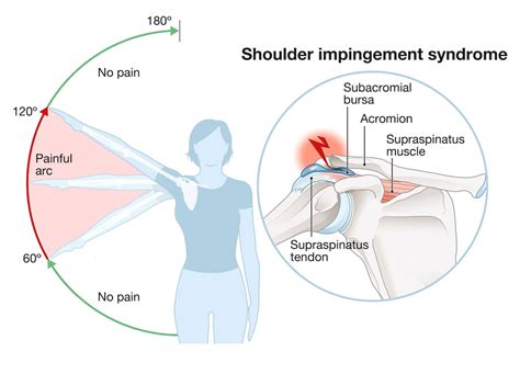Shoulder Impingement Symptoms Causes Treatment By Shoulder Braces