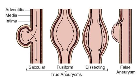 Classifications Of Aneurysms In A True Aneurysm Layers Of The Vessel