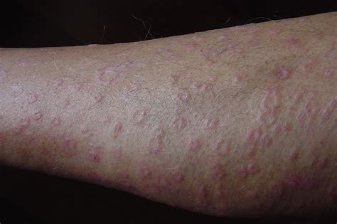 Itchy Rash On Lower Legs Pictures Photos Vrogue Co
