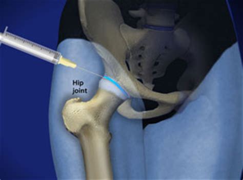 Can be used to identify the source of your hip pain. Hip, Leg, and Knee - Advanced Pain Management Center of ...