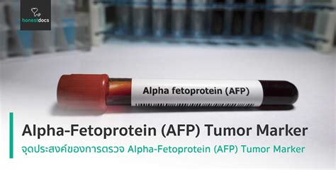 Afp Alpha Fetoprotein Tumor Marker คืออะไร Hd สุขภาพดี เริ่มต้นที่นี่
