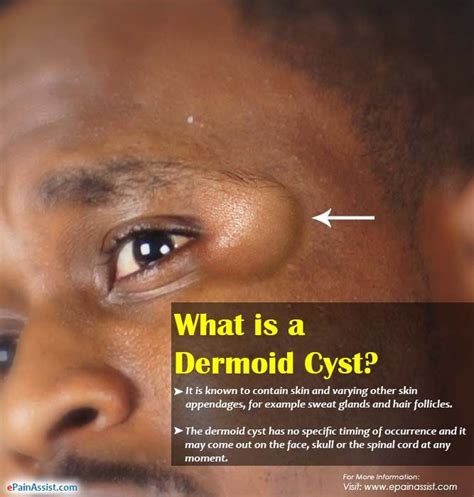 What Is A Dermoid Cyst Dermoid Cyst Cysts Sweat Gland