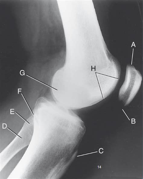 Lateral Knee Radiograph Diagram Quizlet