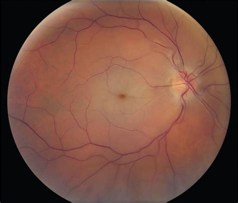 Retina And Vitreous Review Questions In Ophthalmology