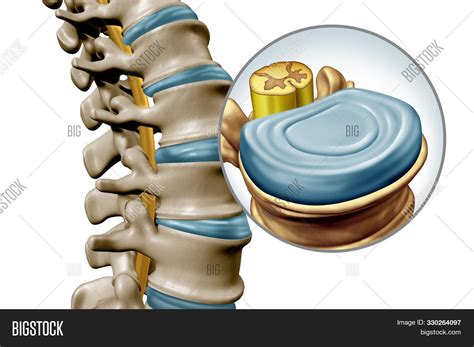 Lumbar Spine Disk Image And Photo Free Trial Bigstock