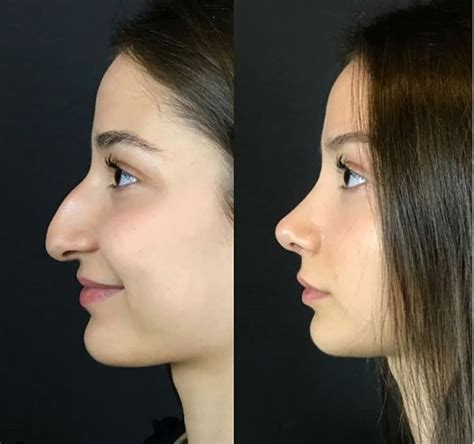Nose Job Before After 2021 Liposuction Before And After Nose Job