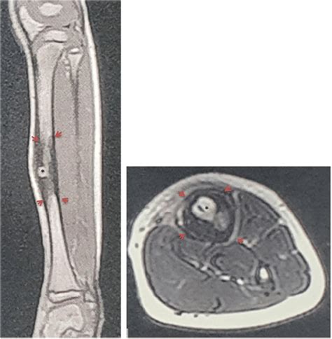 Brodies Abscess On Mri Heterogeneous Signal From The Medulla Of The