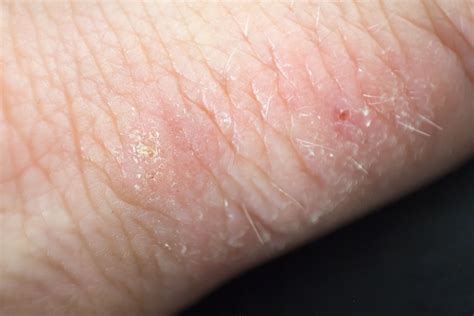 Allergic Contact Dermatitis On Hands Amazing Design Ideas