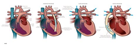 Hypoplastic Left Heart Syndrome Hlhs Diagnosis And Treatment Ssm Health
