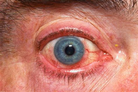 What To Do When The Eyes Have It The Clinical Advisor