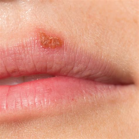 Cold Sores: Symptoms, Causes, Treatment, And More, 53% OFF