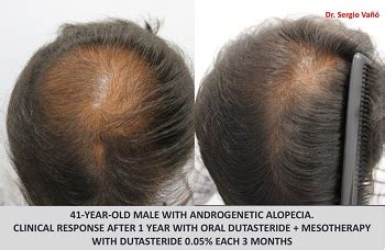 While avodart showed some promise in effectively treating male pattern baldness in two. Dutasteride and Minoxidil Before and After Photos | Hair ...