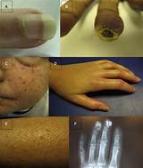 Images of Scleroderma Mayo Clinic