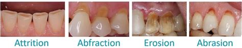 Excessive pressure, repeated contact or certain dental interferences can lead to tension and microscopic flexion, which, if repetitive. Abfraction Tooth Abrasion - The Engineering Internship ...