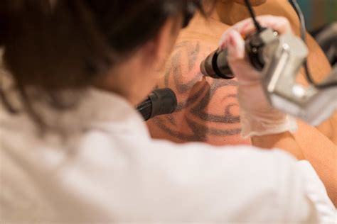 Tattoo Removal Made Easy With Laser Treatments Systeams
