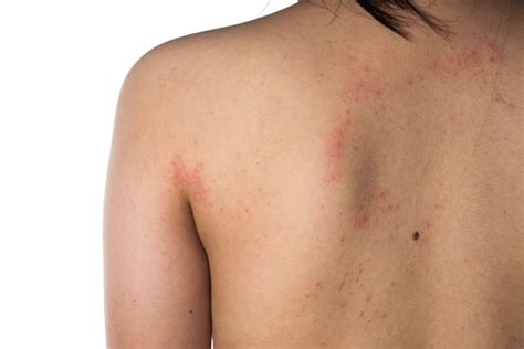 Eczema Severity Time Spent On Management Strongly Associated With