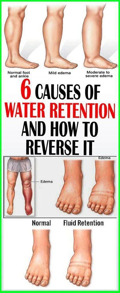 6 Causes Of Water Retention And How To Reverse I In 2020 Water