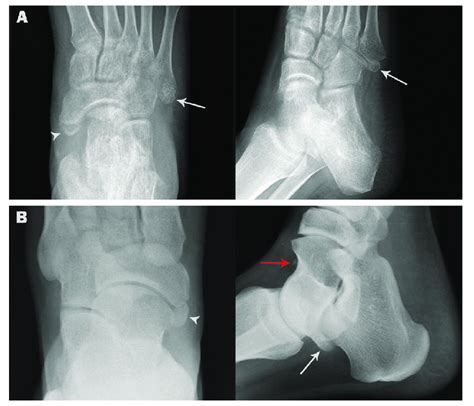 Coexistence Of Accessory Navicular And Other Ossicles In The Same Foot